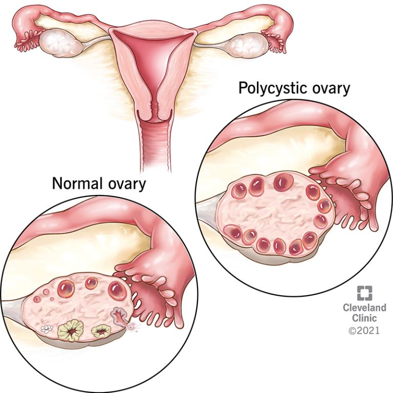 8316-polycystic-ovary-syndrome-pcos