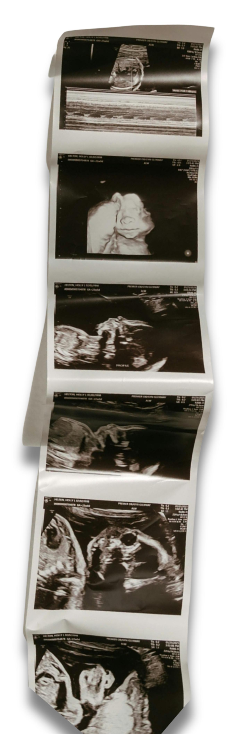 CLICK ANTENATAL SCAN | KLINIK DR. LIYANA