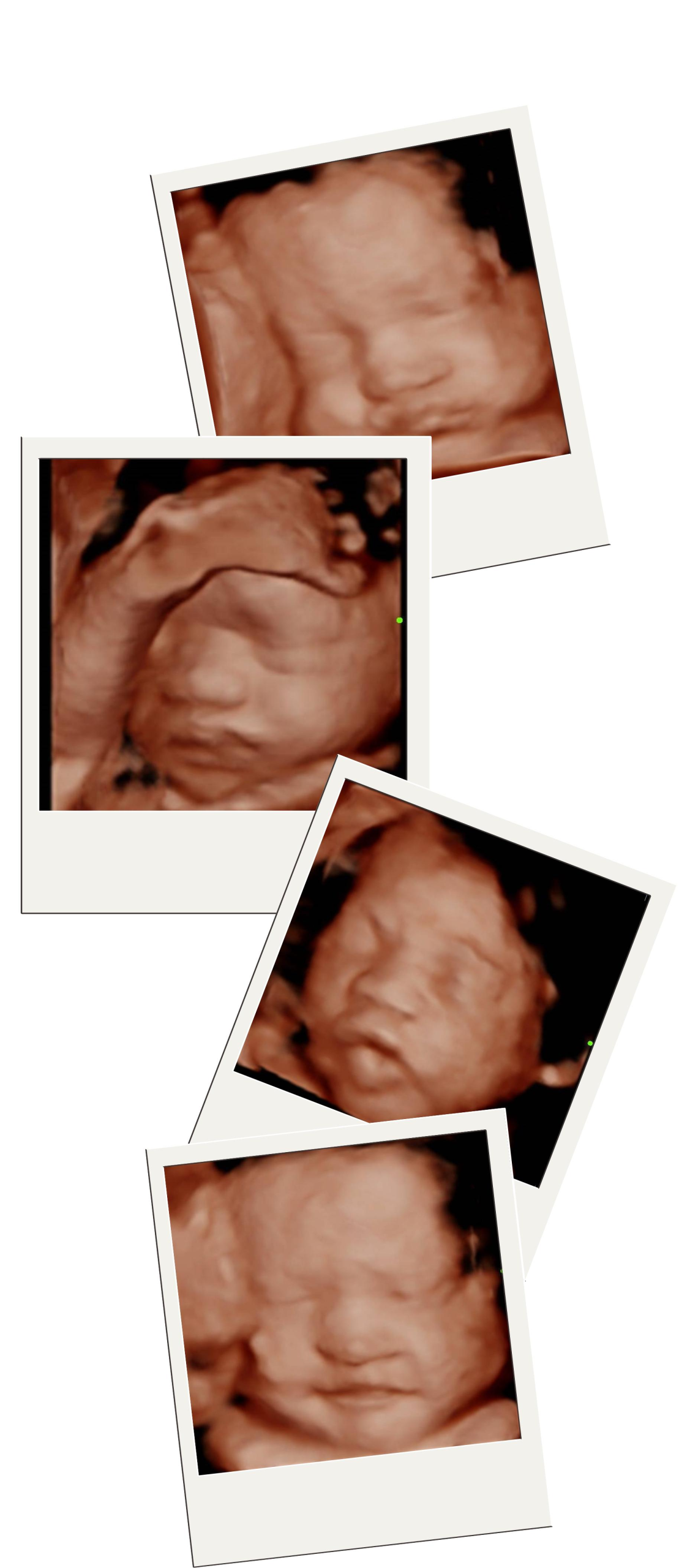 CLICK ANTENATAL SCAN | KLINIK DR. LIYANA